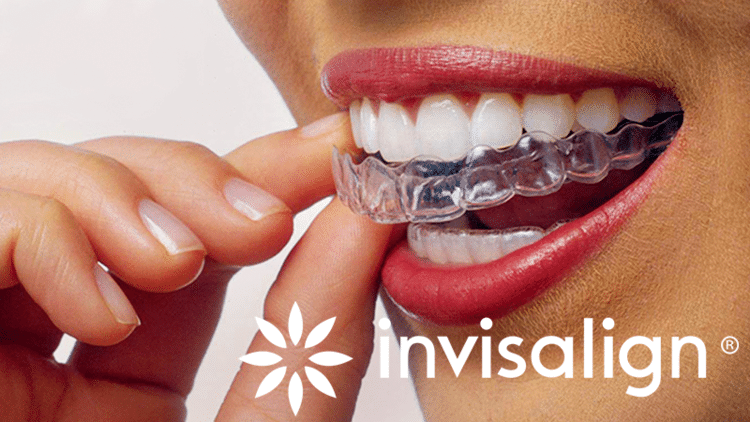 Clear Braces Invisalign Mississauga Tropical Orthodontics