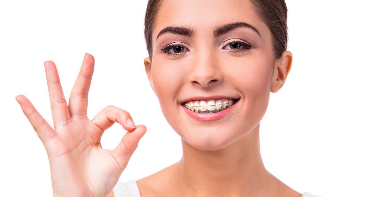 damon system clear braces