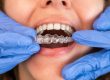 how long invisalign take