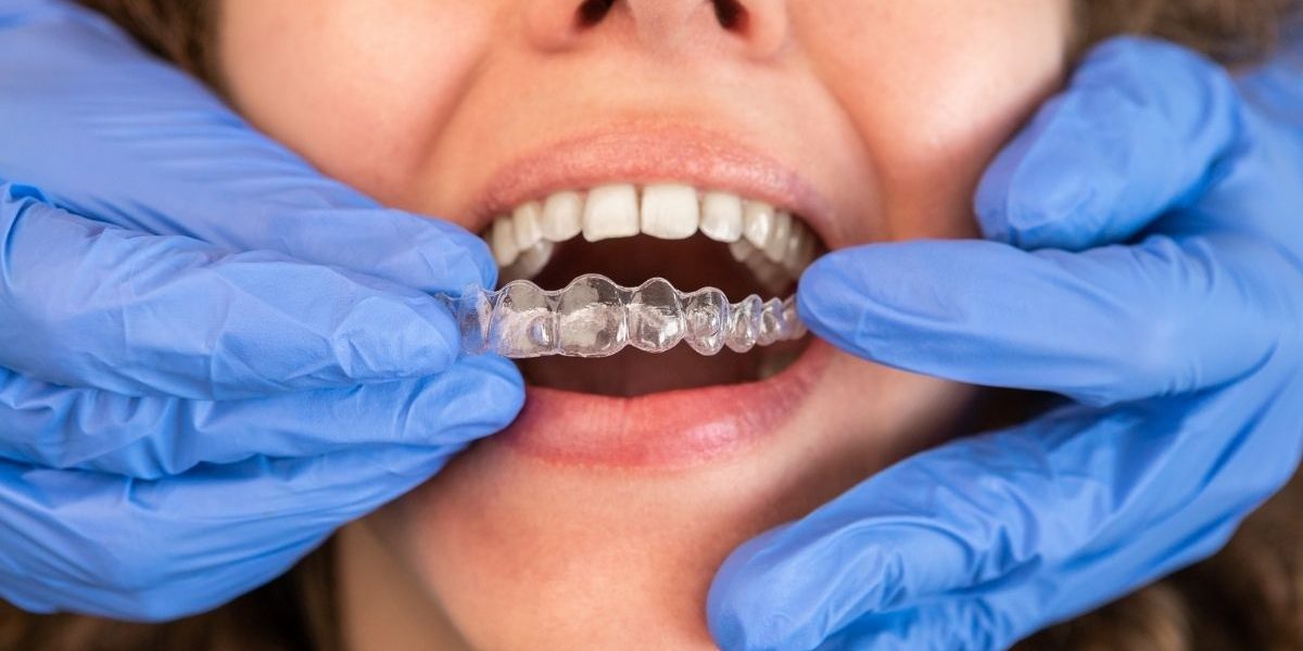 How Long Does Invisalign Take? Insights for Mississauga’s Smiles how long invisalign take