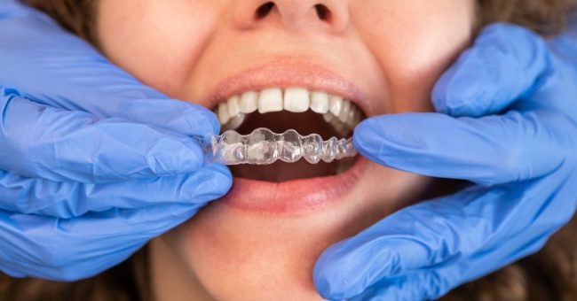 How Long Does Invisalign Take? Insights for Mississauga’s Smiles how long invisalign take