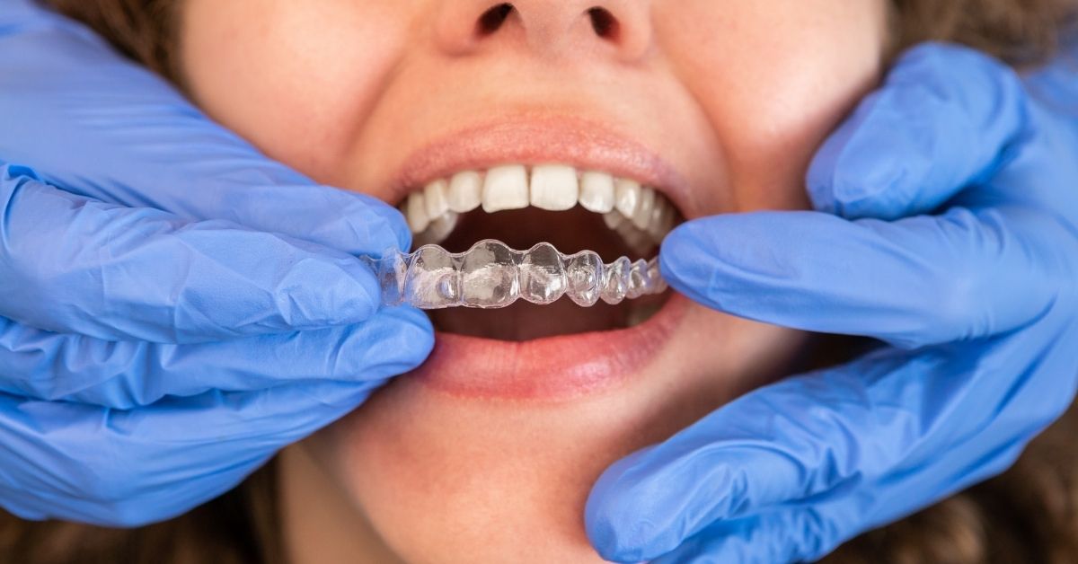 how long invisalign take