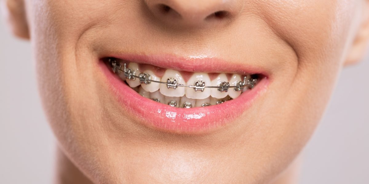 Revolutionizing Orthodontic Care in Toronto: The Pitts 21 Self-Ligating System Explained pitts 21 self ligating brackets