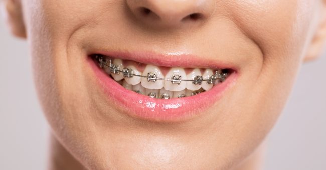 Revolutionizing Orthodontic Care in Toronto: The Pitts 21 Self-Ligating System Explained pitts 21 self ligating brackets