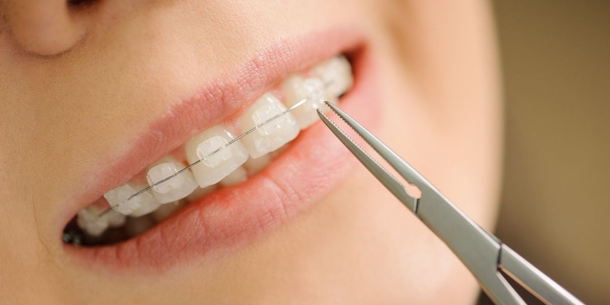 ceramic damon braces cost