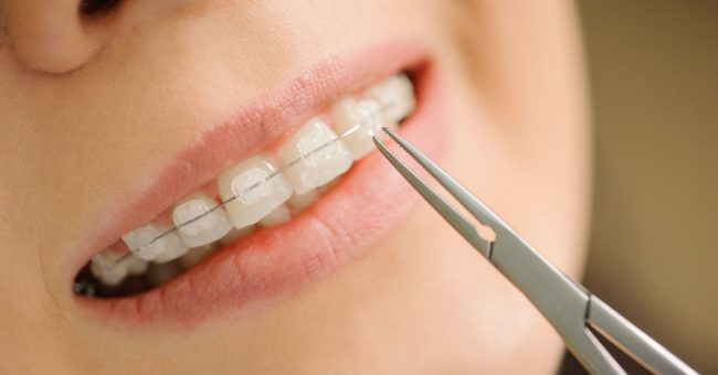 Toronto’s Guide to Damon Clear Braces: Balancing Aesthetics and Affordability ceramic damon braces cost
