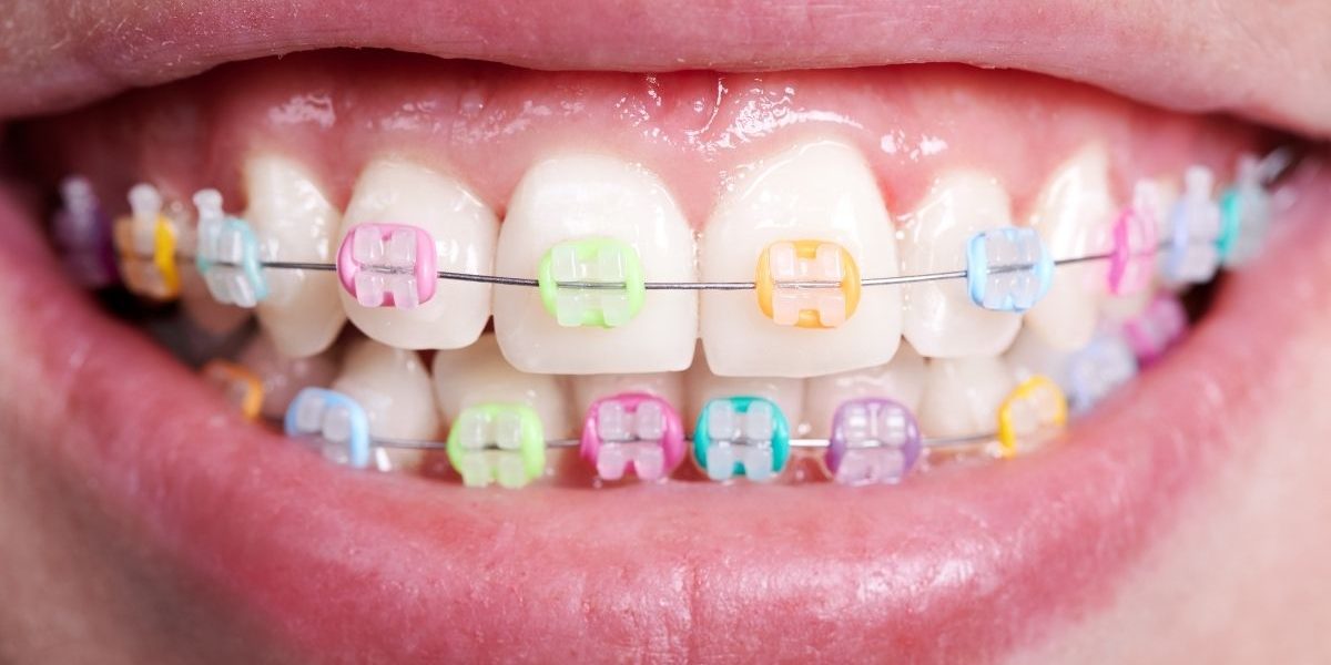 Brighten Your Smile: Exploring Colored Damon Braces in Toronto colored damon braces