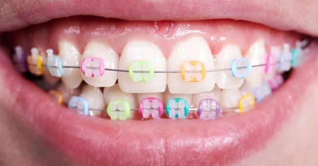 Brighten Your Smile: Exploring Colored Damon Braces in Toronto colored damon braces