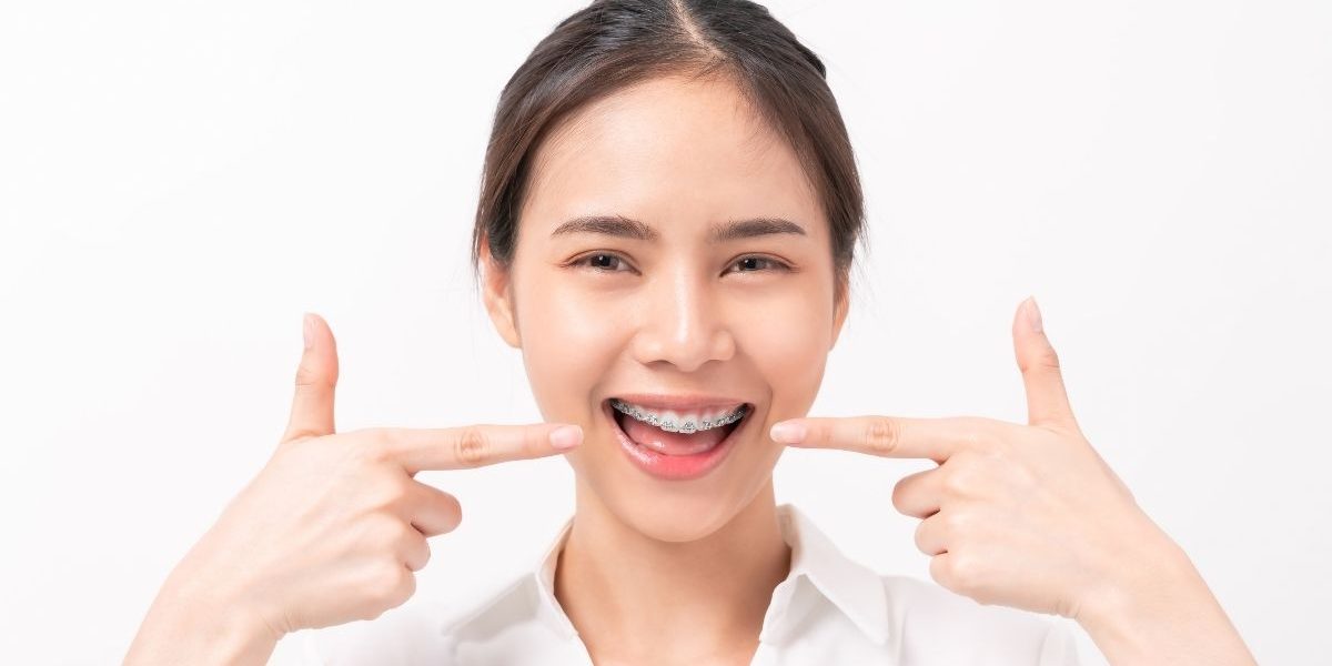 Discover Why More Mississauga Patients Choose Damon Braces for Overbite Correction damon braces for overbite