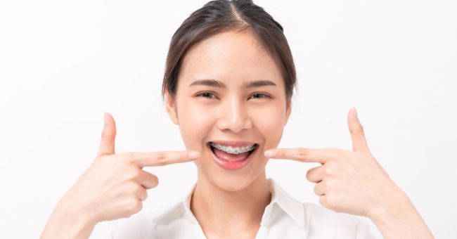 Discover Why More Mississauga Patients Choose Damon Braces for Overbite Correction damon braces for overbite