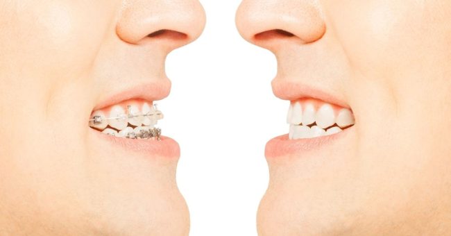 Greater Comfort, Better Results: Toronto’s Experience with Modern Damon Braces damon braces before and after