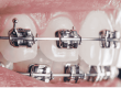 pitts 21 braces