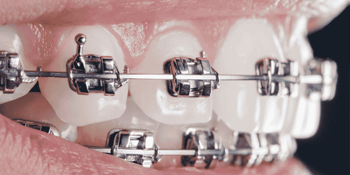 How Pitts 21 Braces Improve Efficiency and Comfort pitts 21 braces