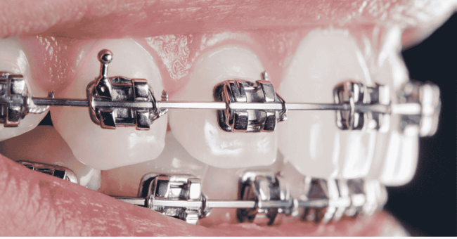 How Pitts 21 Braces Improve Efficiency and Comfort pitts 21 braces