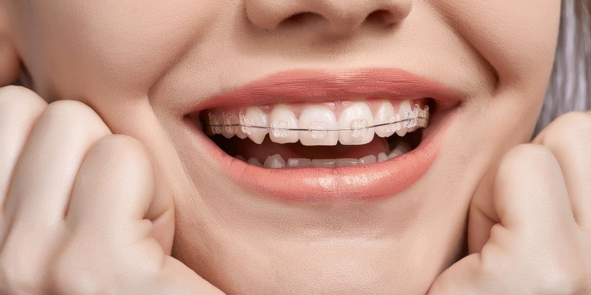 pitts 21 clear brackets