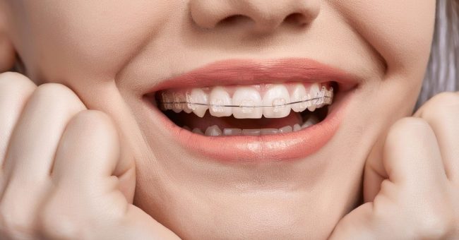 Discover the Aesthetic and Functional Benefits of Pitts 21 Clear Brackets in Toronto pitts 21 clear brackets