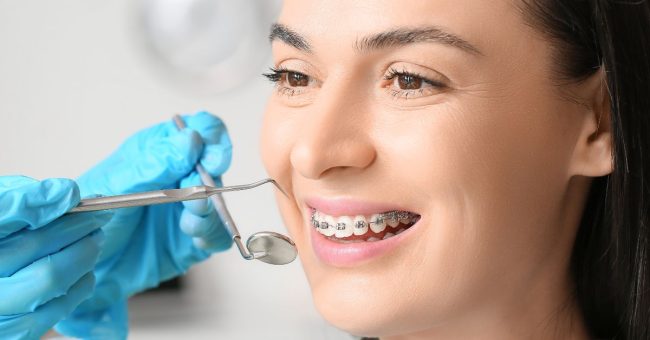 Why Toronto Adults Are Embracing Damon Braces for a Confident Smile adult damon braces