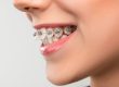 types of braces