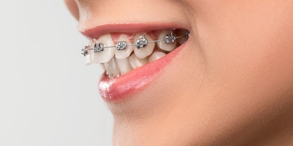 types of braces