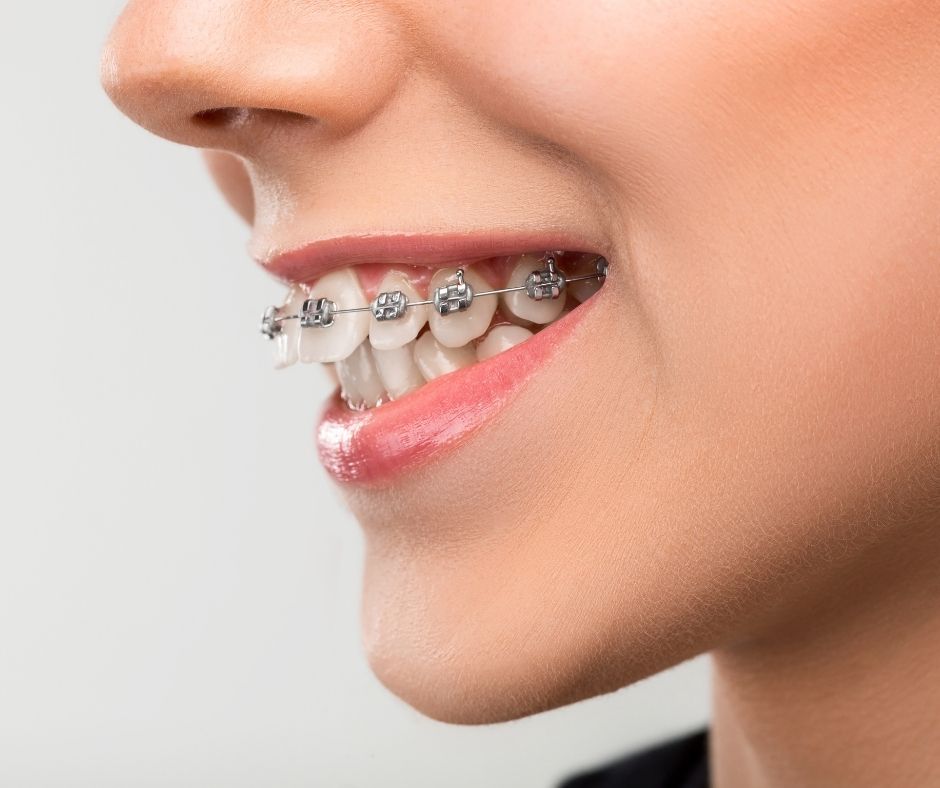 types of braces