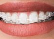 damon ceramic braces