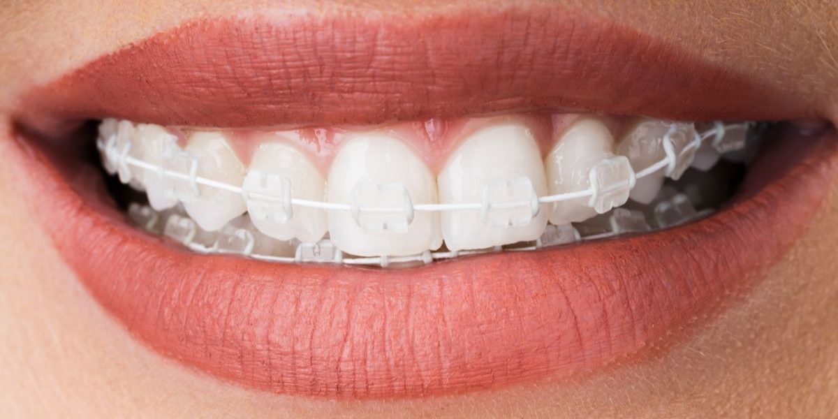 damon ceramic braces