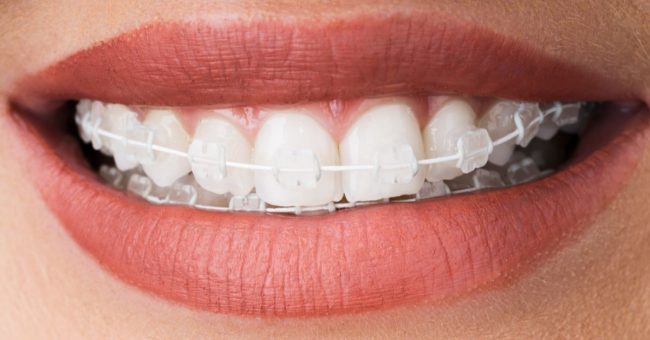 Transform Your Smile in Toronto: The Advantages of Damon Ceramic Braces damon ceramic braces