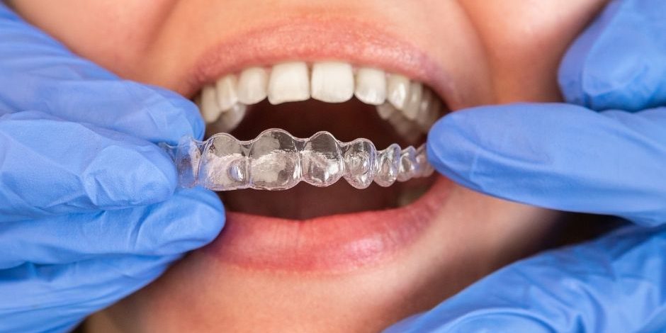 Are Transparent Teeth Braces in Toronto Worth It? Pros & Cons Explained transparent teeth braces