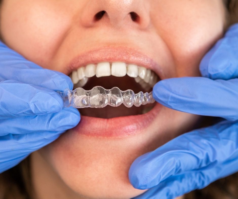 transparent teeth braces