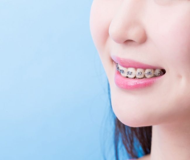 damon braces self ligating