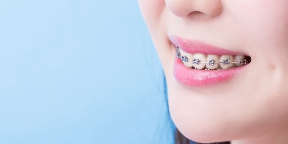 damon braces self ligating