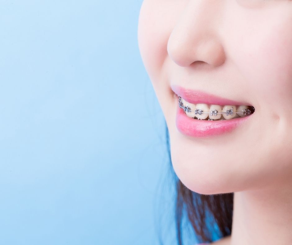 What Are Damon Braces Self-Ligating in Toronto? A 2025 Guide damon braces self ligating