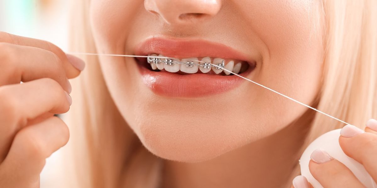 damon clear braces price