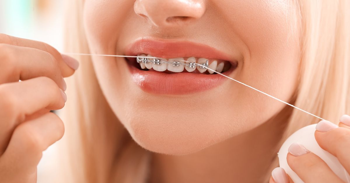 Damon Clear Braces Price: Is the Investment Worth the Smile? damon clear braces price