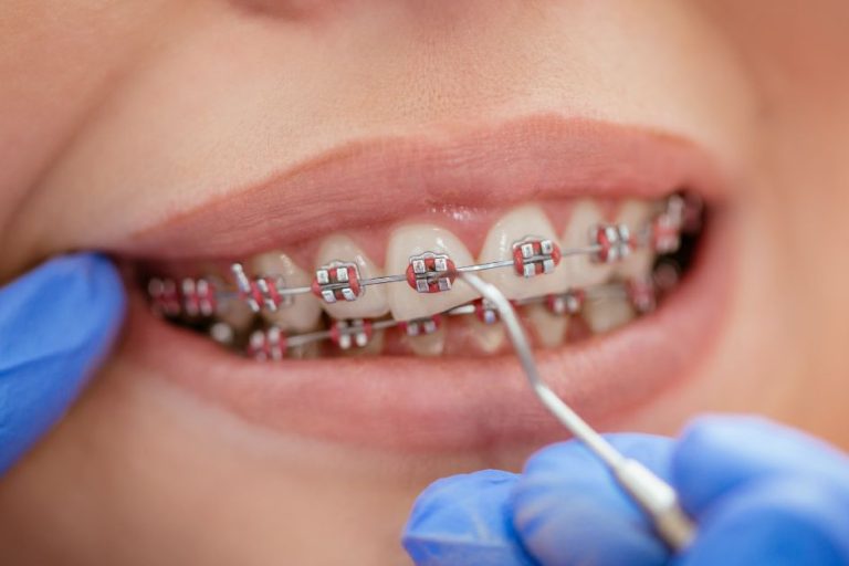 Top Benefits of Choosing Damon System Braces Near Toronto damon system braces near me