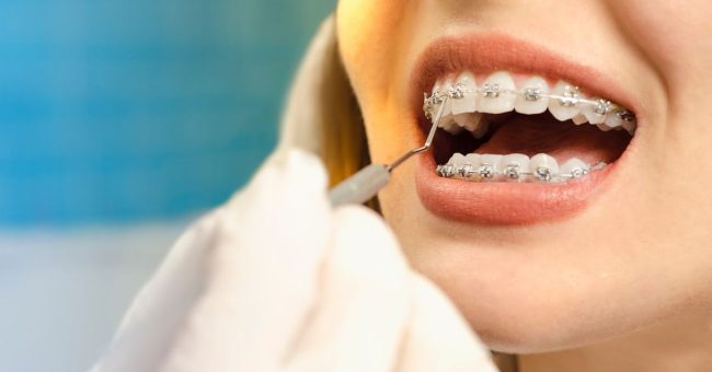 damon ortho brackets near me