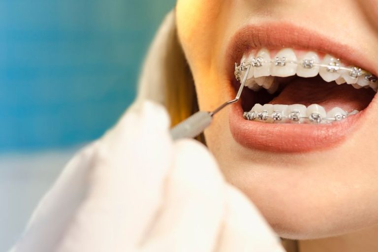 Damon Ortho Brackets Near Toronto: How to Choose the Best Provider damon ortho brackets near me