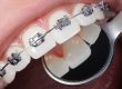 damon dental braces