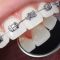 damon dental braces