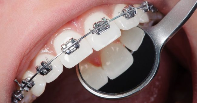damon dental braces