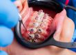 damon ortho brackets