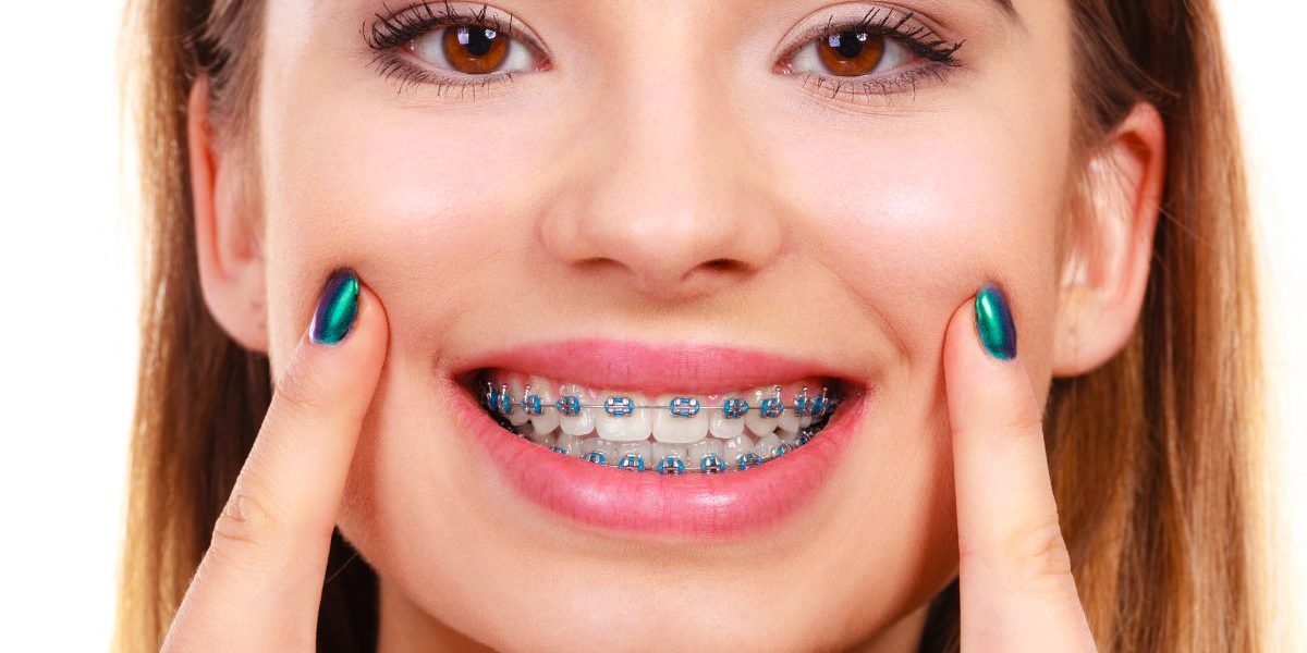 Are White Damon Braces in Toronto Right for You? white damon braces