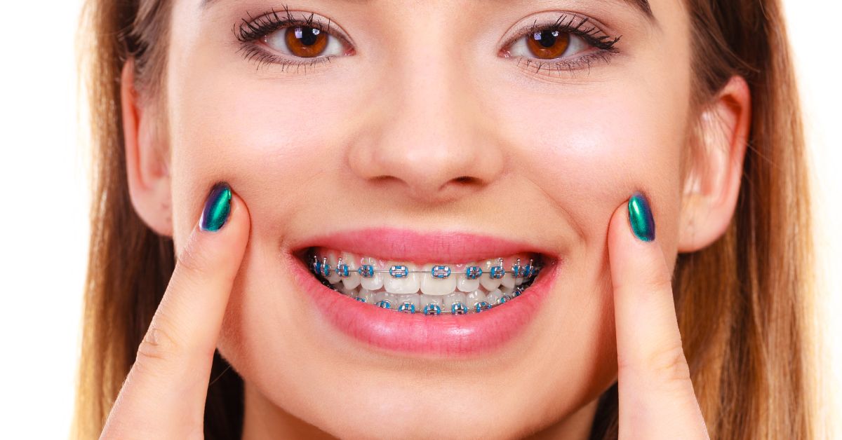 Are White Damon Braces in Toronto Right for You? white damon braces