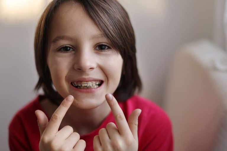 White Damon Braces Near Toronto: Expert Advice for Patients white damon braces near me