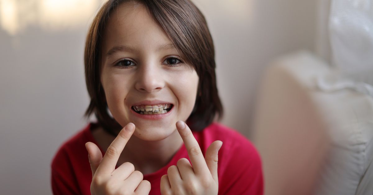 White Damon Braces Near Toronto: Expert Advice for Patients white damon braces near me