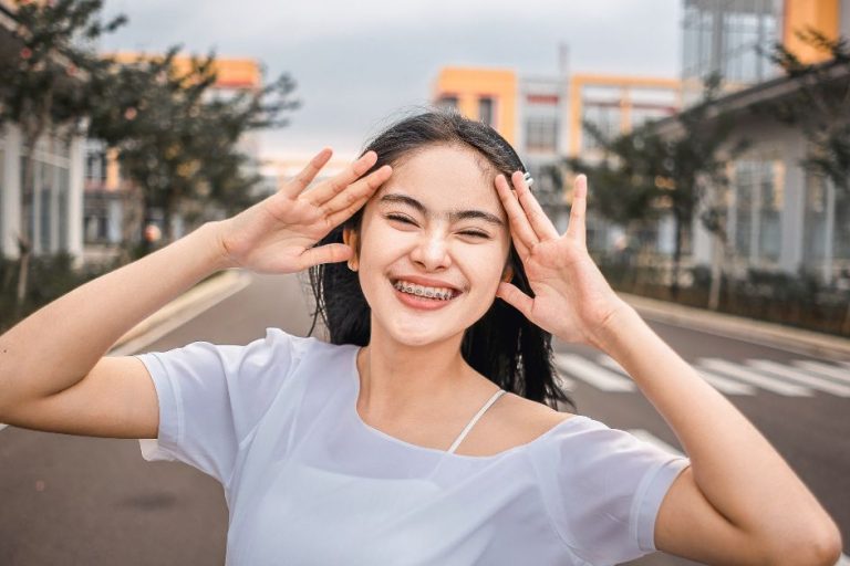 How Damon Fixed Braces Work to Straighten Your Teeth in Toronto damon fixed braces