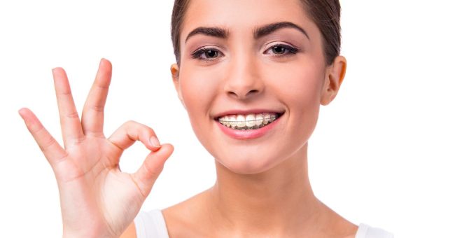 damon fixed braces near me