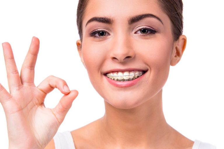 Searching for Damon Braces Near Toronto? Here’s How Orthodontists Can Help damon fixed braces near me