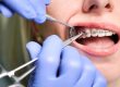 damon fixed braces near me