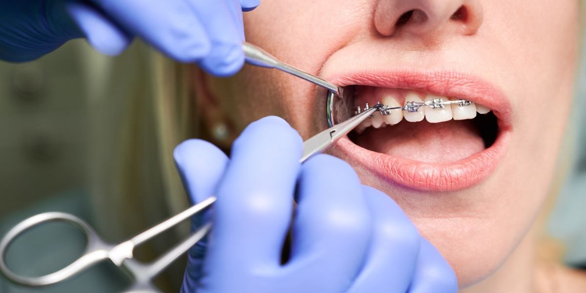 Transform Your Smile with Damon Fixed Braces Near Toronto damon fixed braces near me